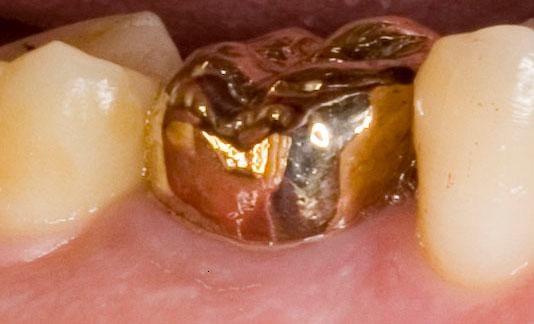 dental gold value calculator showing crown and bridge value